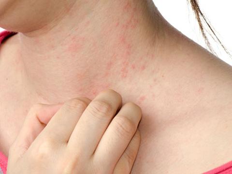 Psoriasis is met CBD goed te verzachten